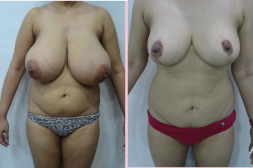 Breast Reduction